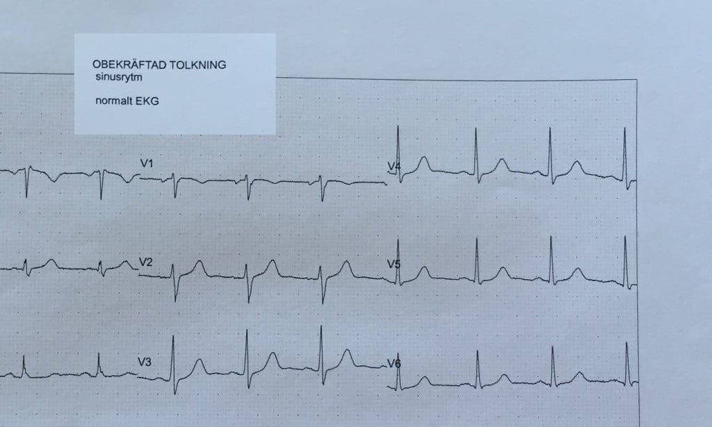 normal EKG